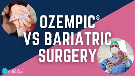 Ozempic Or Bariatric Surgery Which Option Is Best Ozempic Or Bariatric Surgery Which Option Is Best