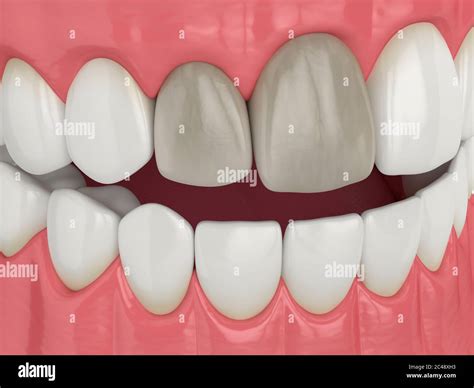 Replace Teeth Hi Res Stock Photography And Images Alamy