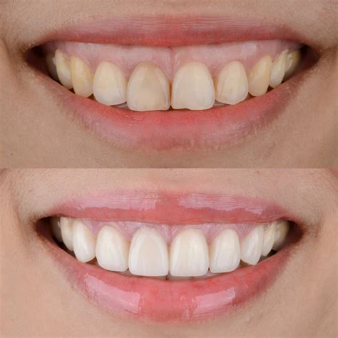 What Can Cause A Gummy Smile And How Can It Be Changed What Can Cause A Gummy Smile And How Can It Be Changed