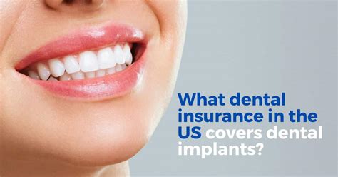 What Dental Insurance In The Us Covers Implants What Dental Insurance In The Us Covers Implants